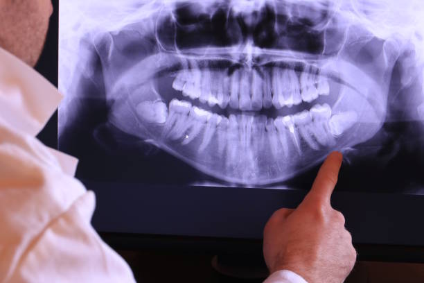 Best Dental Abscess Treatment in Sammamish, WA